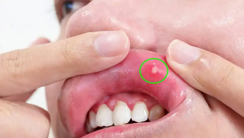 Kanser Belirtilerini Göz Ardı Eden İnsanın Hikayesi: Dilini Kaybetti