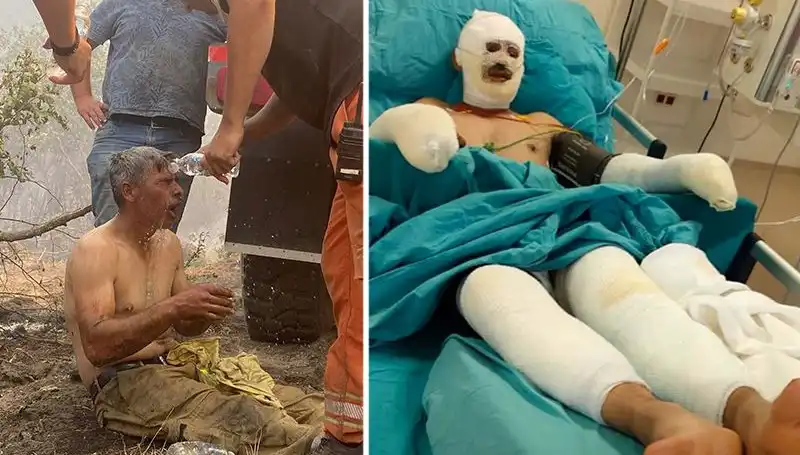 Orman İşçisinin "Yanıyorum" Feryadı, Tedavi Süreci Devam Ediyor