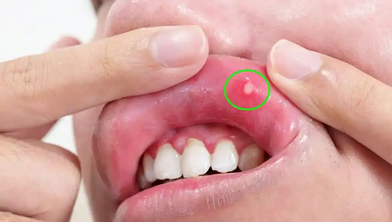 B Vitaminleri Eksikliğinin Sırları: Vücudunuzu Tehdit Edecek 5 Belirti